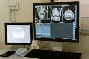 ניתוח MRI של הברך מגלה חריגות קריטיות.