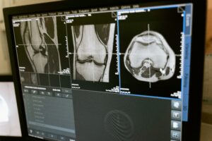 השקפת MRI לגבי מצב סחוס הברך.